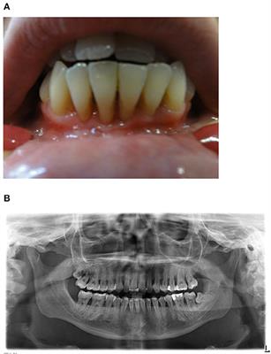 CD70 Deficiency Associated With Chronic Epstein-Barr Virus Infection, Recurrent Airway Infections and Severe Gingivitis in a 24-Year-Old Woman